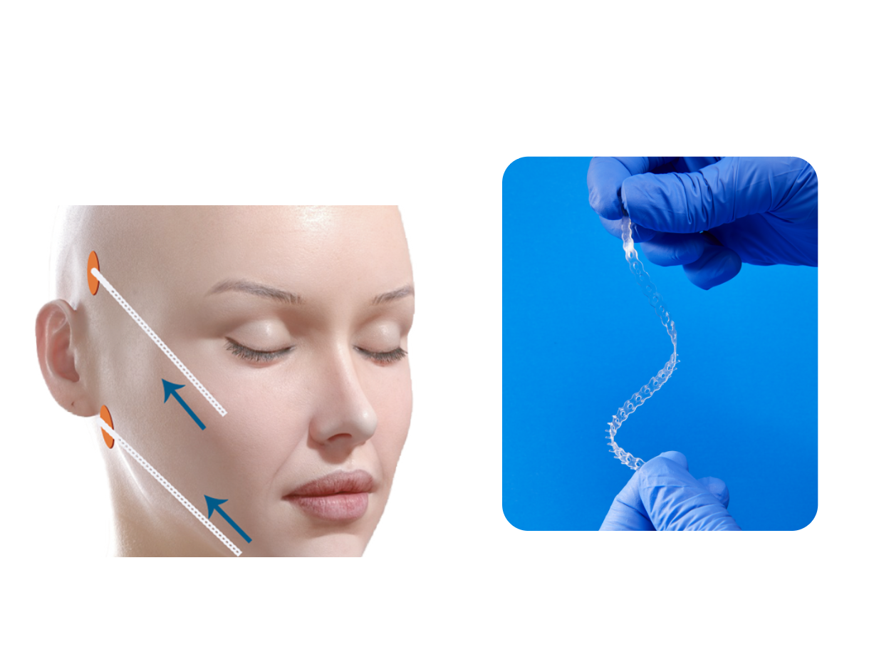 Ribbon™ / Universal Strip™ — Application guide 1
