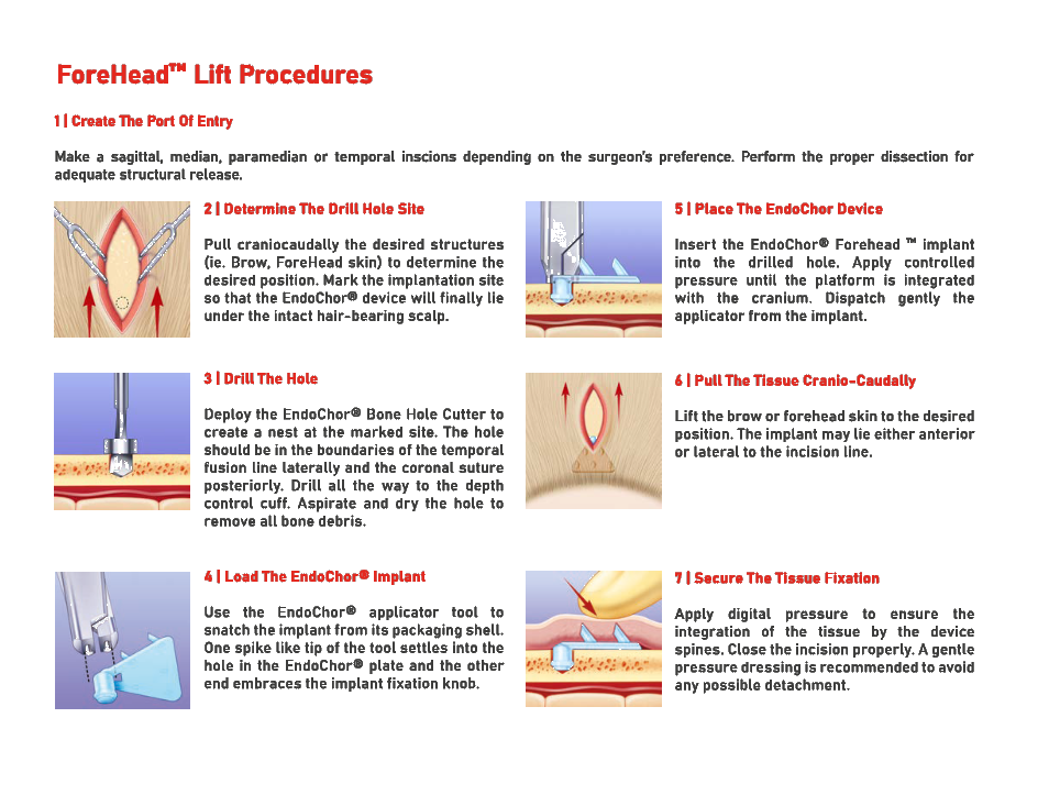 ForeHead™ — Application guide 2
