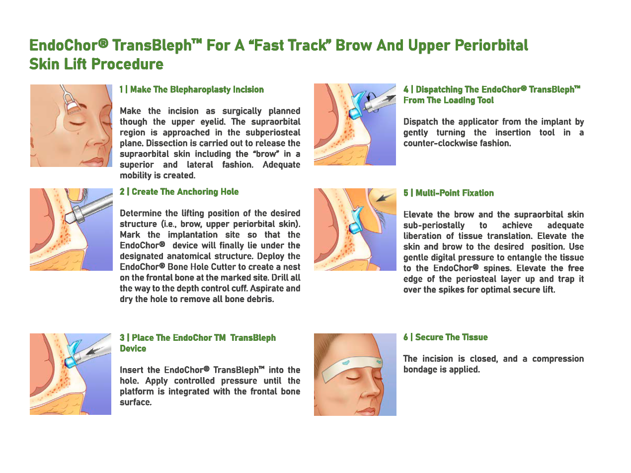 TransBleph™ — Application guide 2