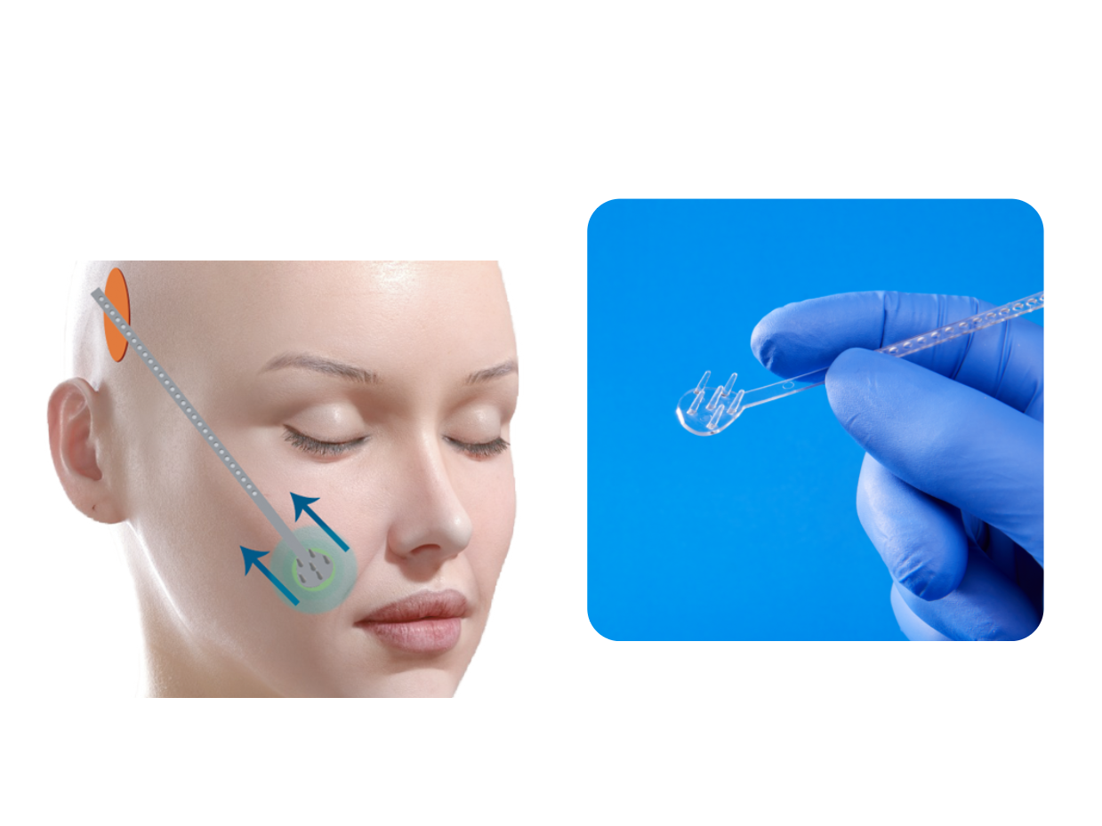 MidFace™ — Application guide 1